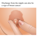 breast discharge