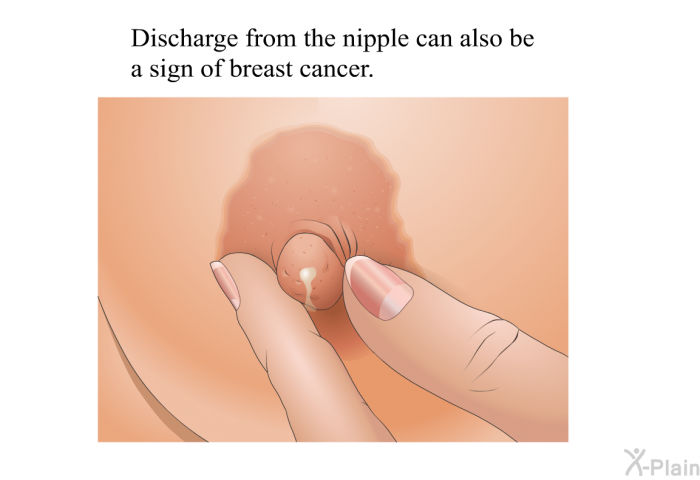 breast discharge